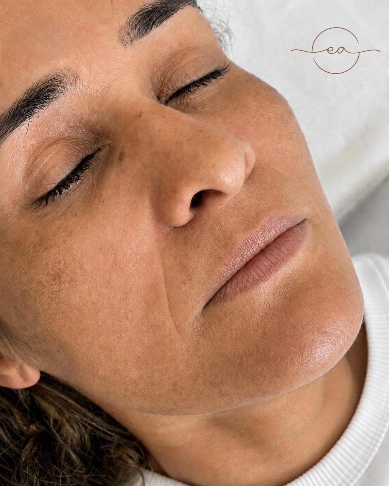 Antes: Microagulhamento Facial em Lisboa