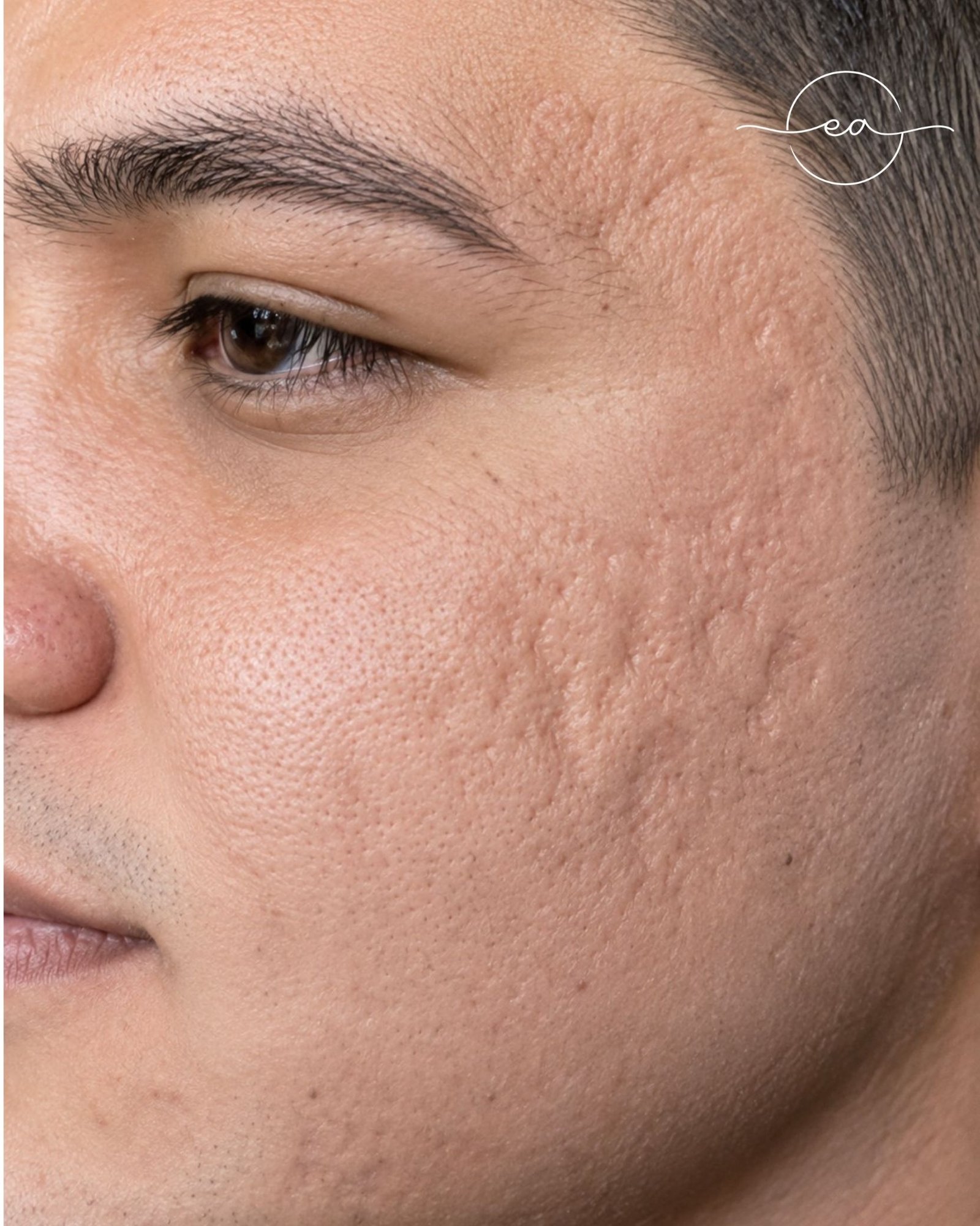 Antes: Microagulhamento Facial em Lisboa